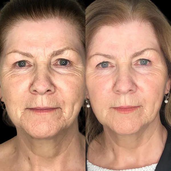 Best Doctors in Dubai for Precision-Based Profhilo Treatment